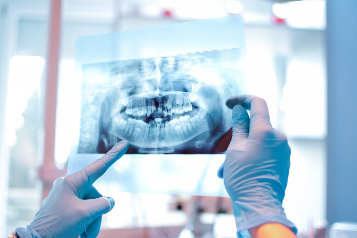 Dentist looking at x-ray for cavities under fillings