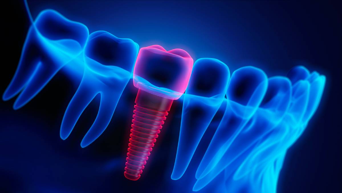 Medical concept image showing dental implants can be removed.