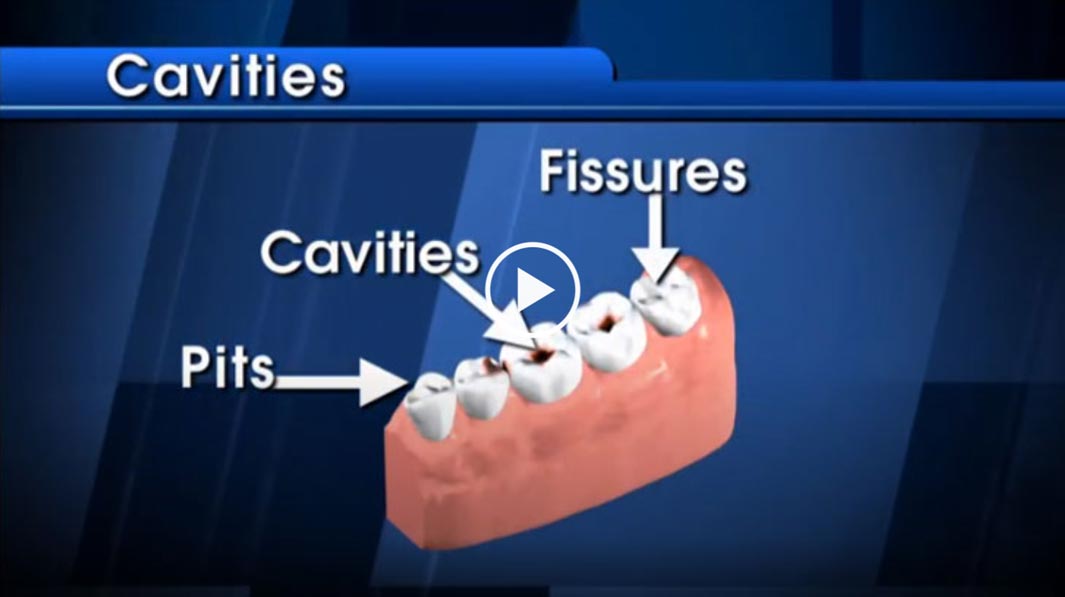 cavities-video