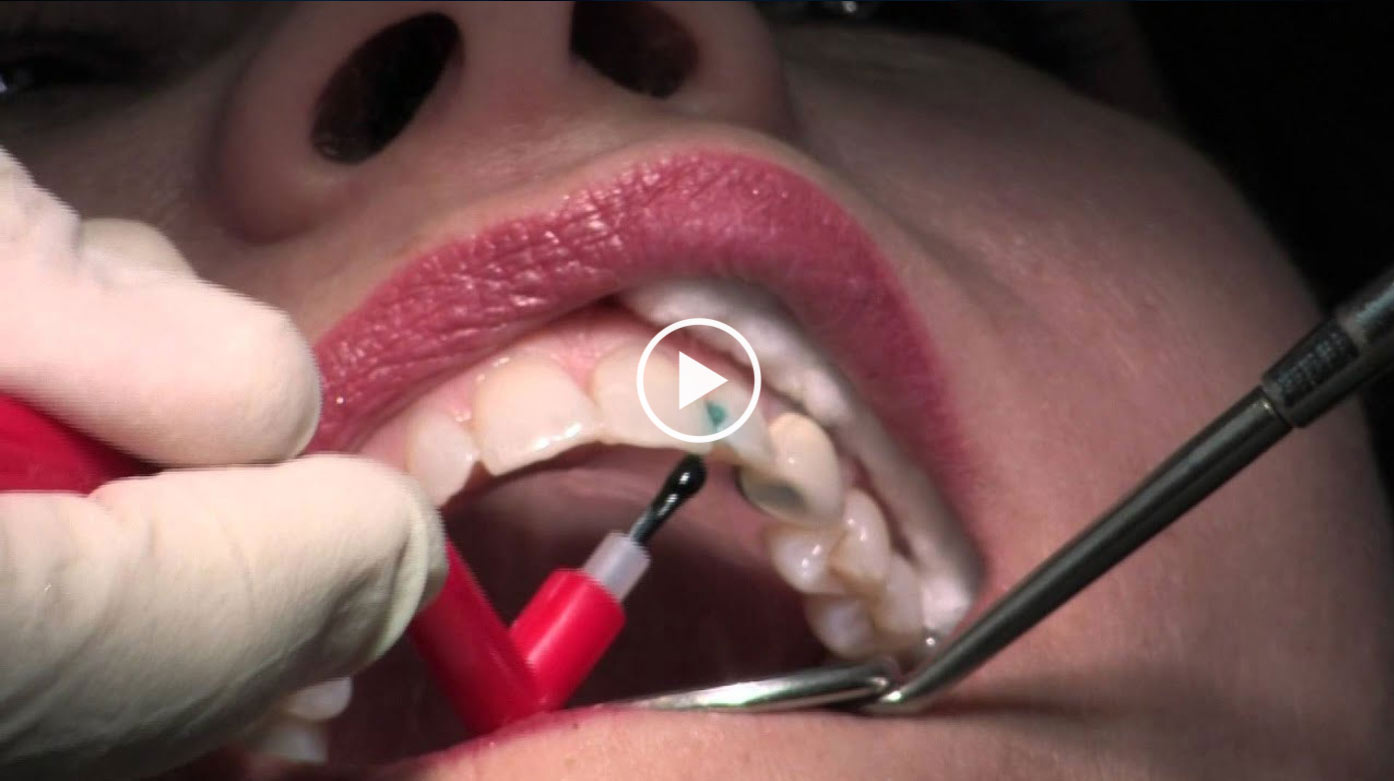 filling-video