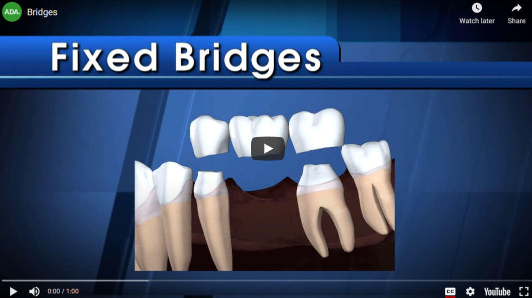 fixed-bridges