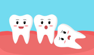 concept image of wisdom teeth ready for removal