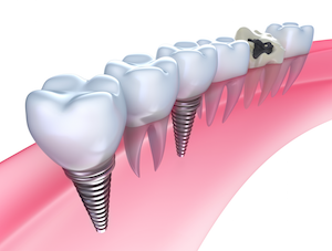 teeth implants