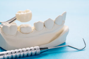 Up close image of a jaw and dental crown