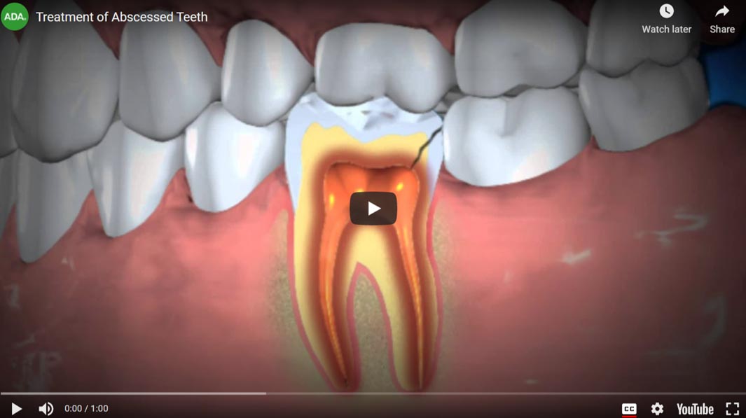 root-canal-video