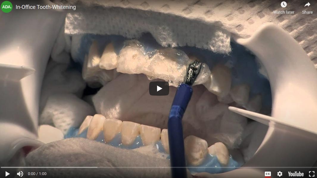 teeth-whitening
