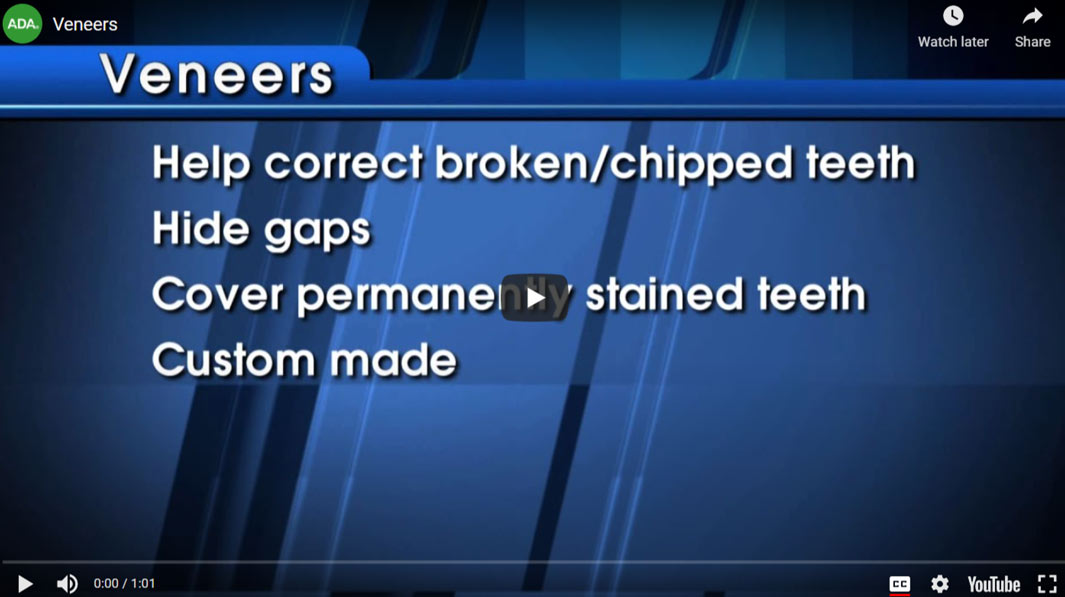 veneer-video
