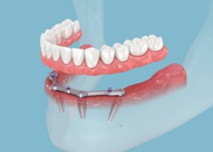 featured image for the 3 types of dentures article