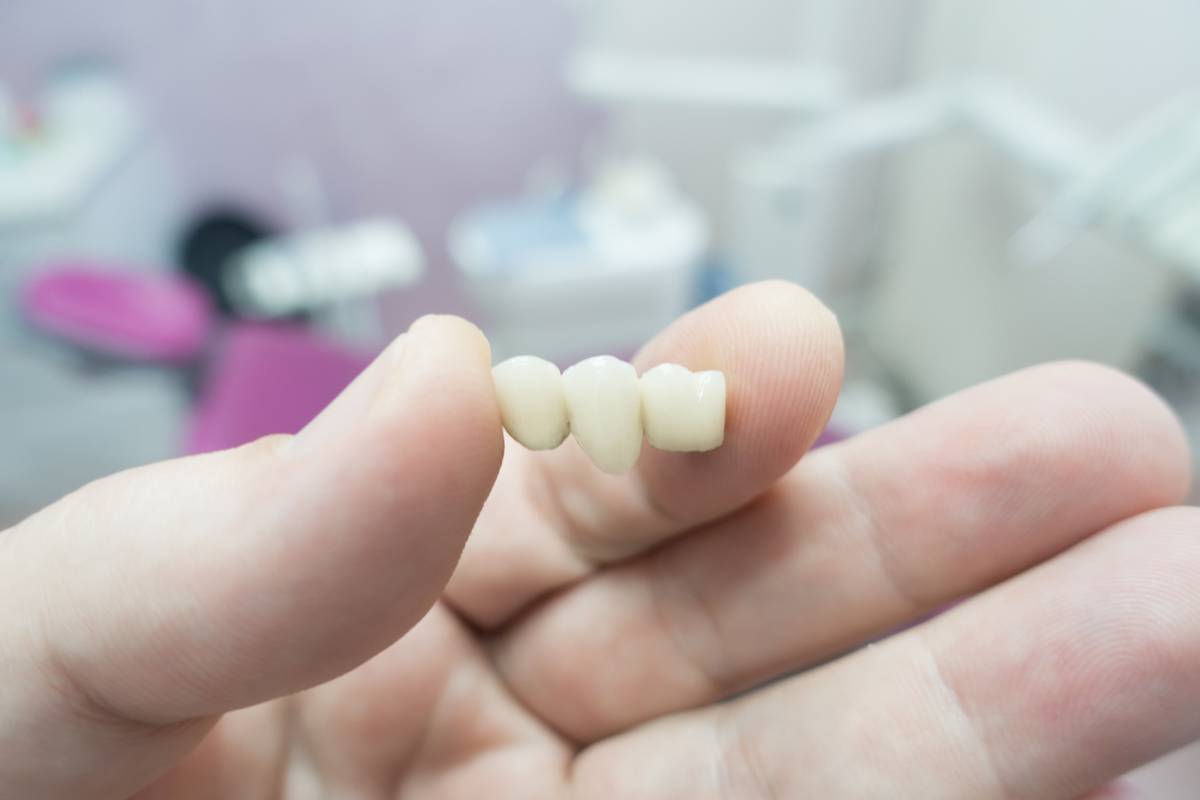 concept for what are the different types of dental bridges