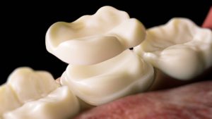 featured image for what to do if a crown falls of your tooth