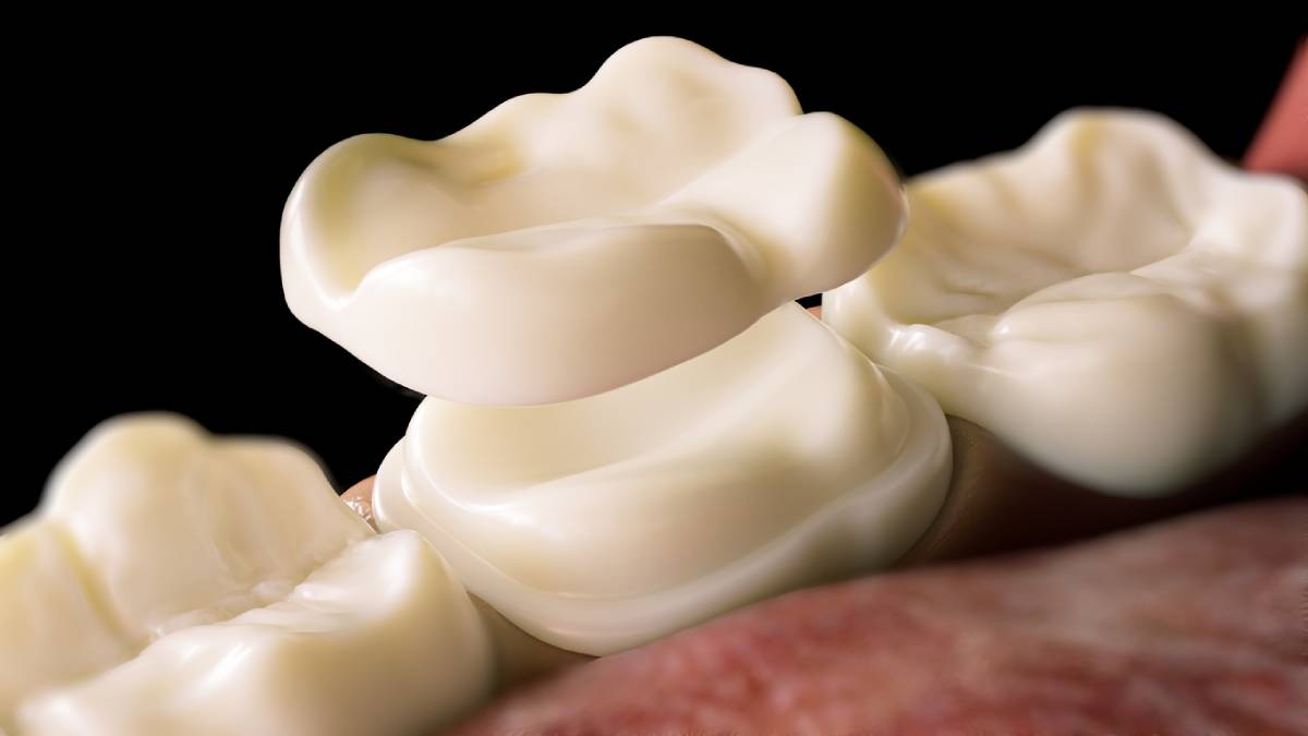 featured image for what to do if a crown falls of your tooth