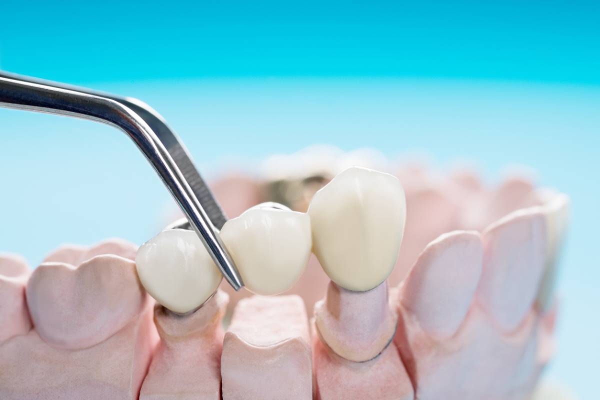 concept of replace dental bridges