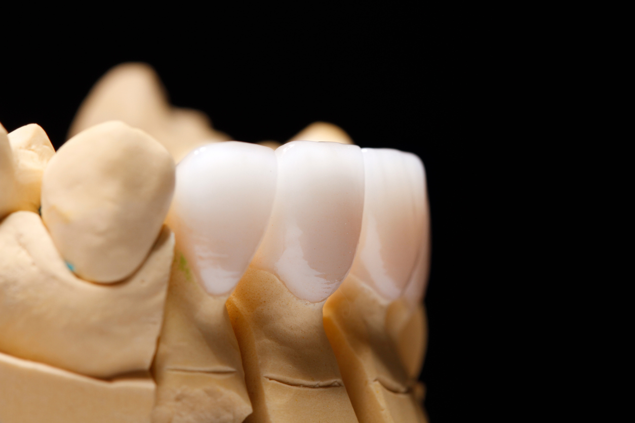 White front teeth veneers on diagnostic model on dark background. Close up.