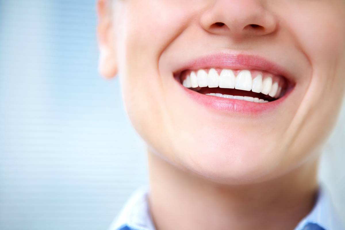 Woman before her veneers started staining